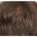 Hair Restoration Before & After Patient #13461