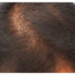 Hair Restoration Before & After Patient #13460