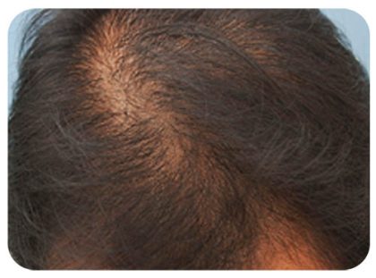 Hair Restoration Before & After Patient #13460