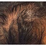 Hair Restoration Before & After Patient #13459