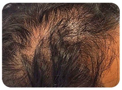 Hair Restoration Before & After Patient #13459