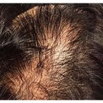 Hair Restoration Before & After Patient #13458