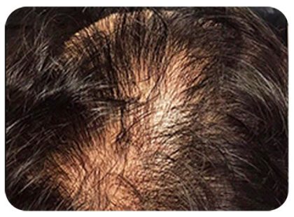 Hair Restoration Before & After Patient #13458