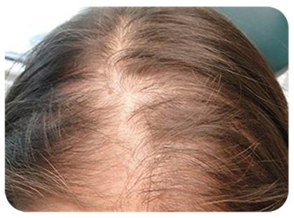Hair Restoration Before & After Patient #13457