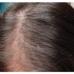 Hair Restoration Before & After Patient #13457