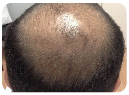Hair Restoration Before & After Patient #13456