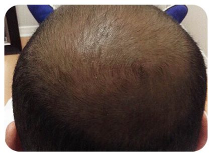 Hair Restoration Before & After Patient #13456