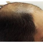 Hair Restoration Before & After Patient #13455
