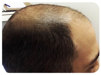 Hair Restoration Before & After Patient #13455