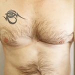Laser Hair Removal Before & After Patient #13342