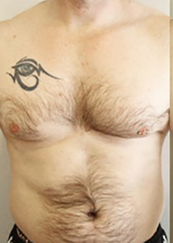 Laser Hair Removal Before & After Patient #13342