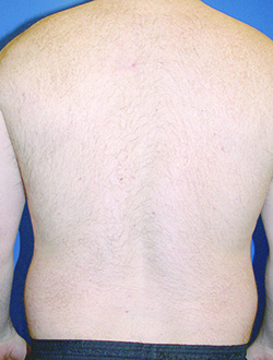 Laser Hair Removal Before & After Patient #13341