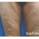 Laser Hair Removal Before & After Patient #13339