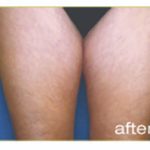 Laser Hair Removal Before & After Patient #13339