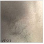 Laser Hair Removal Before & After Patient #13338