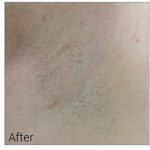 Laser Hair Removal Before & After Patient #13338