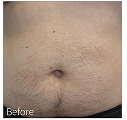 Laser Hair Removal Before & After Patient #13337