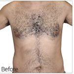 Laser Hair Removal Before & After Patient #13336