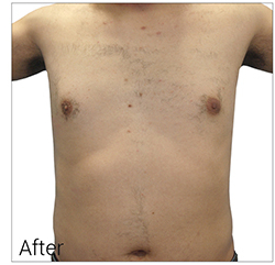 Laser Hair Removal Before & After Patient #13336