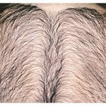 Laser Hair Removal Before & After Patient #13333