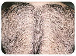 Laser Hair Removal Before & After Patient #13333
