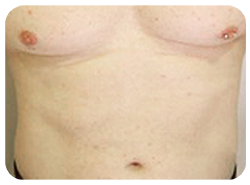 Laser Hair Removal Before & After Patient #13332