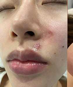 Microneedling Before & After Patient #13271