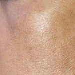Microneedling Before & After Patient #13252