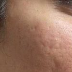 Microneedling Before & After Patient #13249