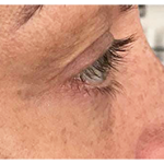 Microneedling Before & After Patient #13262