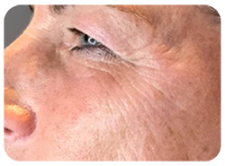 Microneedling Before & After Patient #13260