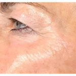 Microneedling Before & After Patient #13260
