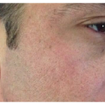 Microneedling Before & After Patient #13259