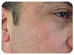 Microneedling Before & After Patient #13259