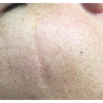 Microneedling Before & After Patient #13257