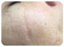 Microneedling Before & After Patient #13257