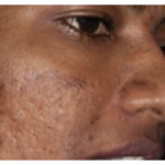Microneedling Before & After Patient #13255