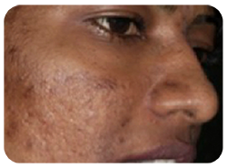 Microneedling Before & After Patient #13255