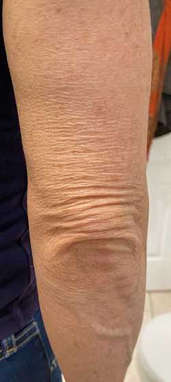 Microneedling Before & After Patient #13244