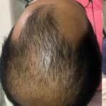 Hair Restoration Before & After Patient #13418