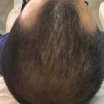 Hair Restoration Before & After Patient #13418