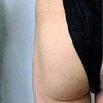 Butt Lift Before & After Patient #14031