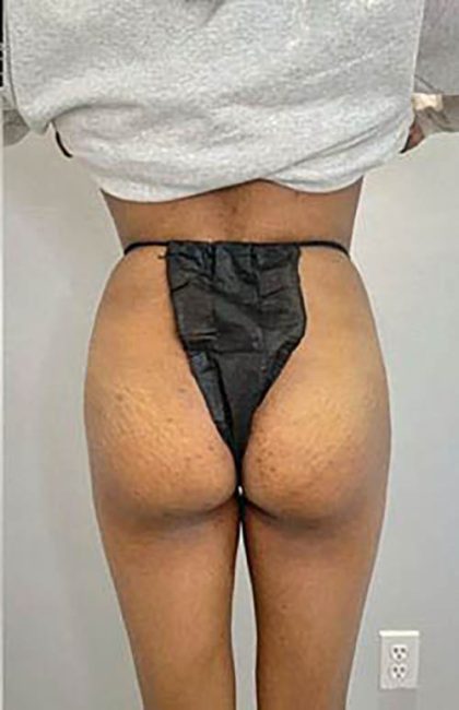 Butt Lift Before & After Patient #14031