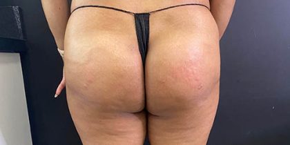 Butt Lift Before & After Patient #14012