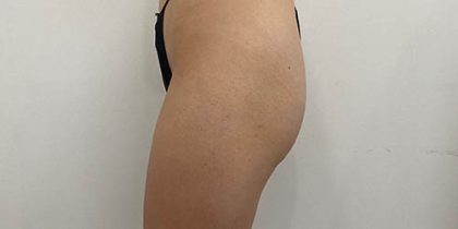 Butt Lift Before & After Patient #14011