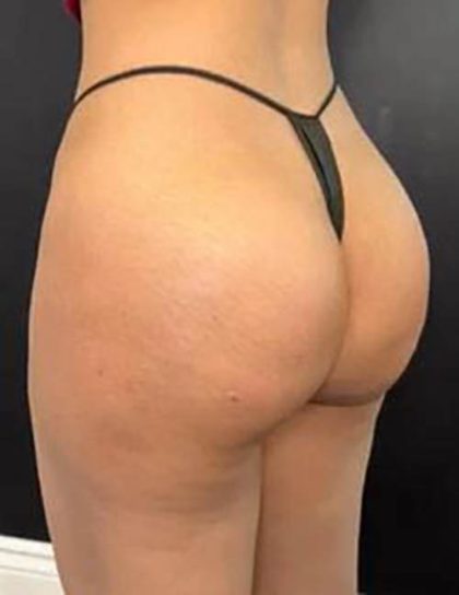 Butt Lift Before & After Patient #14013