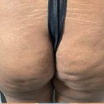 Butt Lift Before & After Patient #14008