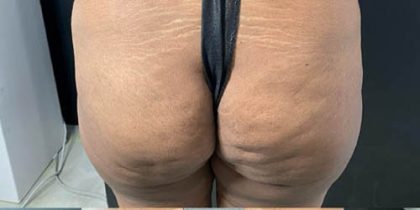 Butt Lift Before & After Patient #14008