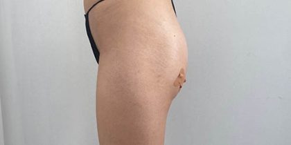 Butt Lift Before & After Patient #14006