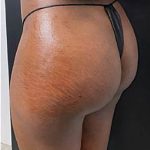 Butt Lift Before & After Patient #14005